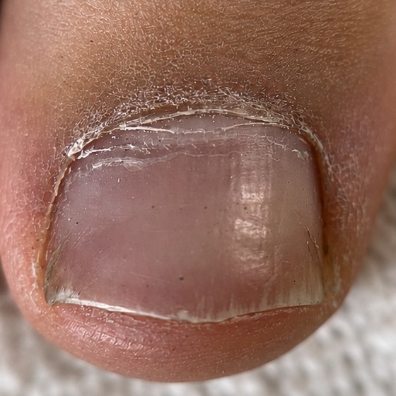 Toenail before a KOVA pedicure